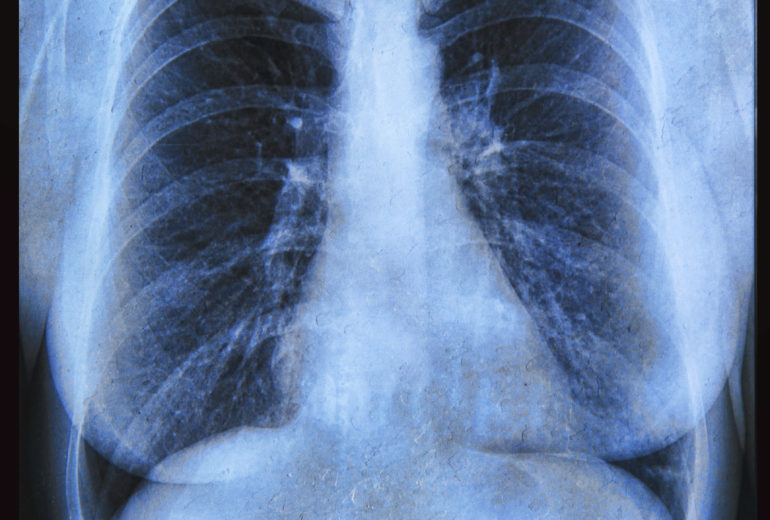 Porque Pessoas Com Fibrose Cistica Nao Podem Ficar Perto